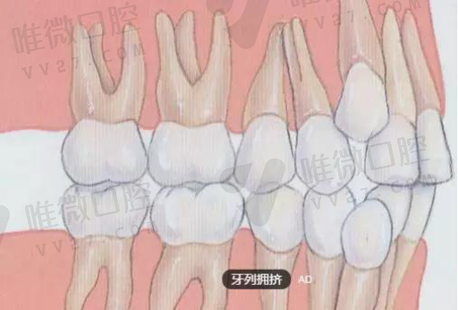 龋洞浅可以用窝沟封闭吗,牙齿窝沟封闭和涂氟的区别(图1)